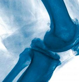 Артроскопія колінного суглоба