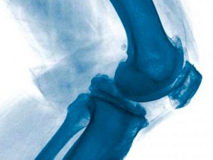 Артроскопія колінного суглоба