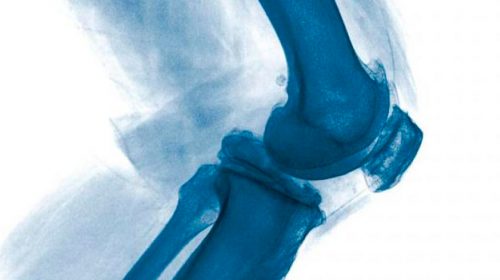 Артроскопія колінного суглоба